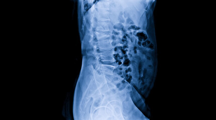 Plain radiograph on dark background in hospital.The x-ray is used for diagnosis of the illness of...