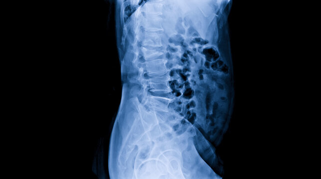 Plain radiograph on dark background in hospital.The x-ray is used for diagnosis of the illness of patient.Medical concept.Compression fracture lumbar spine in osteoporosis or osteopenia patient.