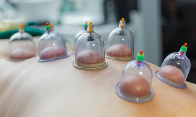 Massage vacuum cups. Close-up of a man lying with cans on his back in a spa. Vacuum jars in treatment and cosmetology. Vacuum therapy. Cup massage, selective focus. - obrazy, fototapety, plakaty