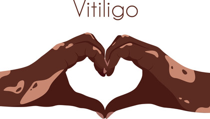 Two hands with vitiligo patches in the shape of a heart. Self love concept. World Vitiligo Day. I love my skin. Brown skin with a patch of vitiligo. Skin diseases. Self care 