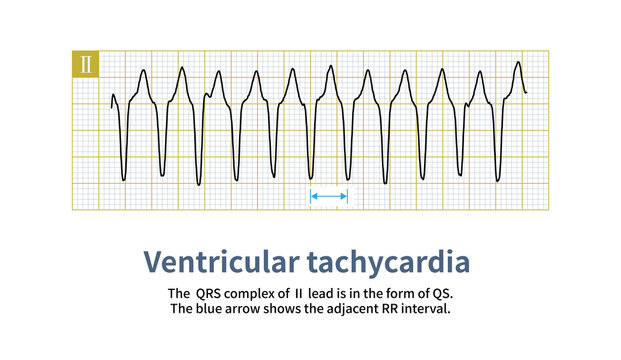 The QRS wave of ventricular tachycardia can be either a wide QRS wave or a narrow QRS wave, which depends on the origin site and activation sequence of ventricular tachycardia in the ventricle.