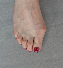 White female foot with bunion or hallux valgus. - obrazy, fototapety, plakaty