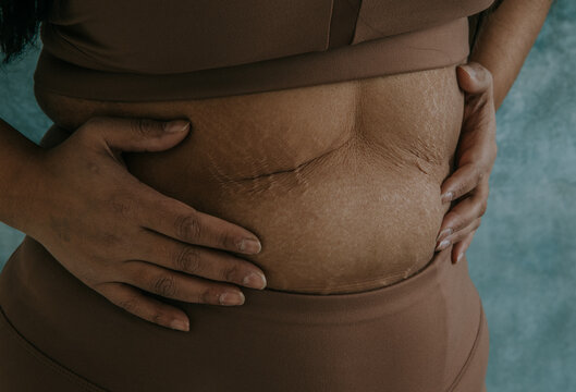 closeup of East Indian woman's hands on belly with stretchmarks