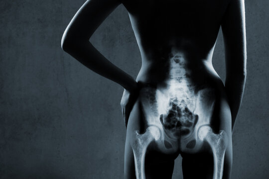 Human hip joint in x-ray on gray background. X-ray image of painful hip in woman.