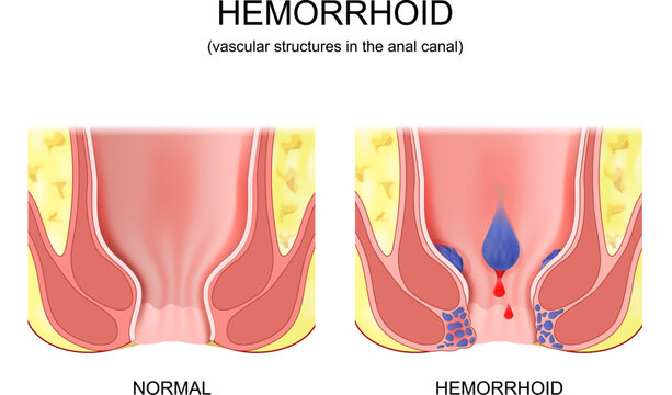 piles. comparison and difference between healthy colon and hemorrhoidal disease.