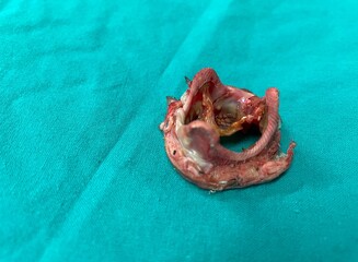 Degenerative mitral valve (MV) prosthetic in patient status postoperative mitral valve replacement...