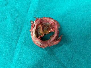Degenerative mitral valve (MV) prosthetic in patient status postoperative mitral valve replacement...