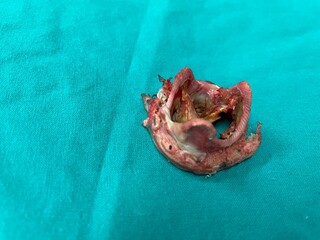 Degenerative mitral valve (MV) prosthetic in patient status postoperative mitral valve replacement...
