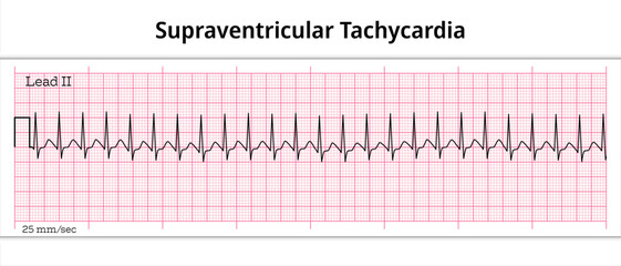 ECG Supraventricular Tachycardia - 8 Second ECG Paper - Electrocardiography Vector Medical Illustration
