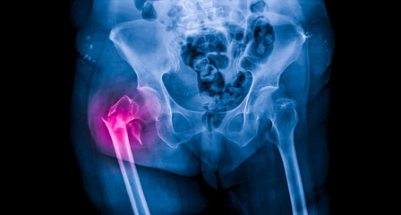 Radiograph on dark background in hospital.The xray is used for diagnosis of the illness of...
