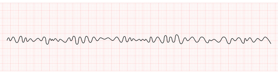EKG Monitor Showing Ventricular Fibrillation or VF