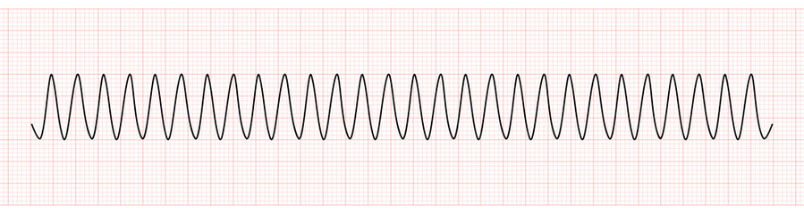 EKG Monitor Showing Ventricular tachycardia or VT