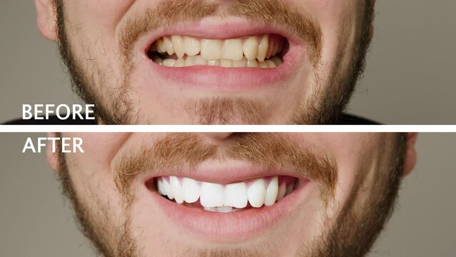 Collage of two superimposed pictures without background, before and after, with white writing, with a man's teeth. Teeth whitening treatment. Man smiling broadly after teeth whitening procedure