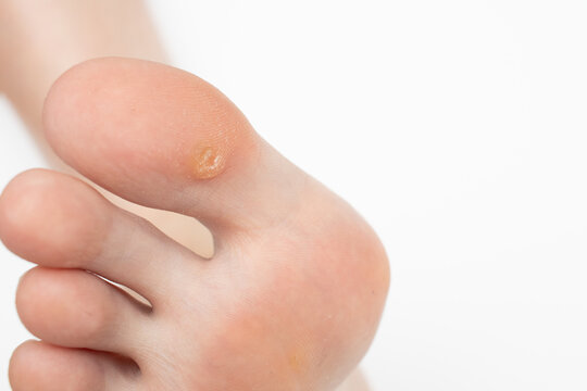 Wart on the big toe. Plantar wart on foot. Foot with corns, calluses, verrucas.