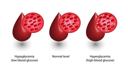 Blood Glucose Levels. Normal level, hypoglycemia (low blood sugar), hyperglycemia (high blood sugar), sugar test. Blood droplet. vector diagram illustration. - obrazy, fototapety, plakaty