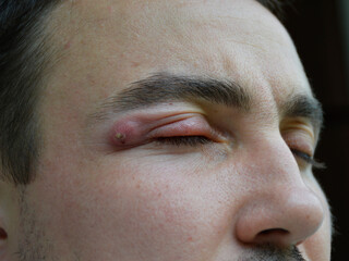 boil - a strong purulent abscess in a man near the eye. swelling from the infection has spread to the upper eyelid