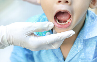 doctor screening and diagnosis mouth of tongue-tie patient , dental health problem, children show...