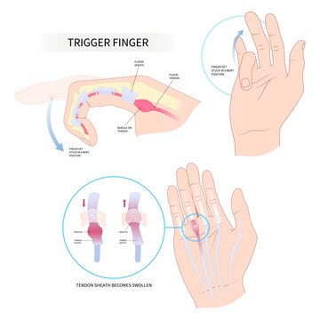 diabetes palm hand cyst flexor pain anatomy medical and Dupuytren's gout index lock tendon wrist bump nodule middle ring bump bend get stuck sheath inflamed swollen lump muscle examine join bone