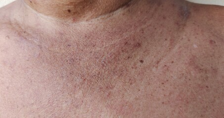 close up of a person with a skin infections, rash hives itchy skin on the body, blackhead and...