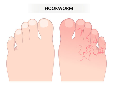 Skin rash pain feet parasitic worm intestinal small large bowel colon gut stool poor larvae poop eye larva soil Weight loss dirt