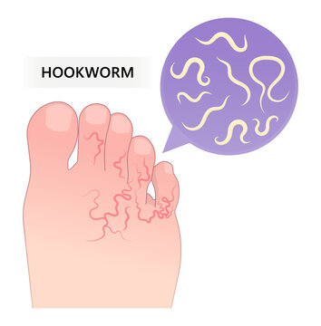 feet pain parasitic worm intestinal small large bowel colon gut stool poor larvae poop rash eye larva soil Weight loss dirt