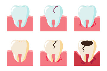 vector set, isolated illustrations cartoon style. good health tooth and unhealthy yellow plaque, broken tooth and swollen gums.