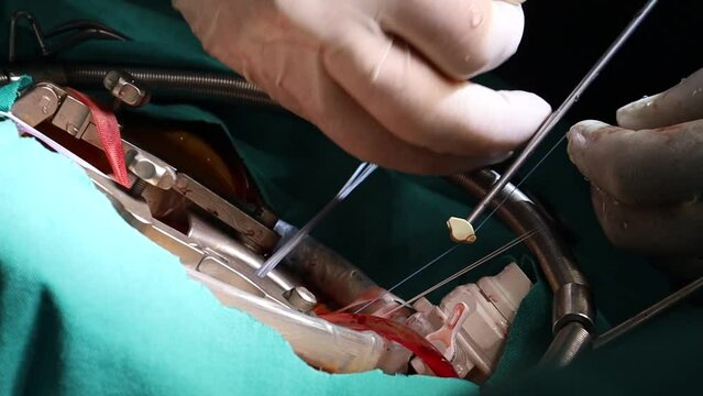 Heart surgery suturing. Heart surgery close-up at doctor hands.