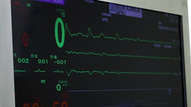Pumping heart stopping in surgery. Screen monitoring dying patient. Vital signs dropping. Clinical death stock video.