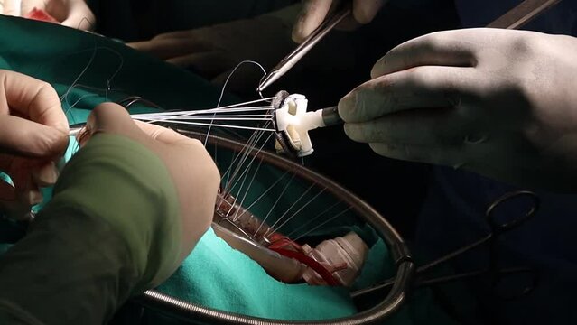 Suturing artificial heart valve. Close-up doctor hands and heart valve during cardiac surgery. By-pass procedure.