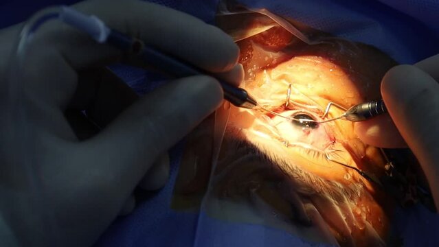 Close-up eye surgery. Surgical procedure stock video.