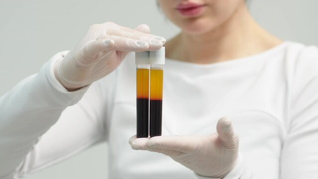 Doctor-cosmetologist in white coat and blue gloves demonstrates blood collection tube with centrifuged blood - separated platelet rich plasma | PRP footage 3 of 6