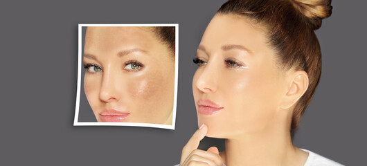Dark spots, freckles,hyperpigmentation(melasma or chloasma),concept - skin lightening, skin whitening, fruit acids,AHA, Skin Brightening