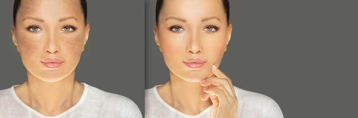 Fototapeta premium Dark spots, freckles,hyperpigmentation(melasma or chloasma),concept - skin lightening, skin whitening, fruit acids,AHA, Skin Brightening