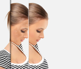 Dark spots, freckles,hyperpigmentation(melasma or chloasma),concept - skin lightening, skin whitening, fruit acids,AHA, Skin Brightening