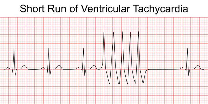 Electrocardiogram short run of ventricular tachycardia (VT). Cardiac fibrillation. Heart beat. ECG. EKG. Vital sign. Life support. Medical healthcare symbol.