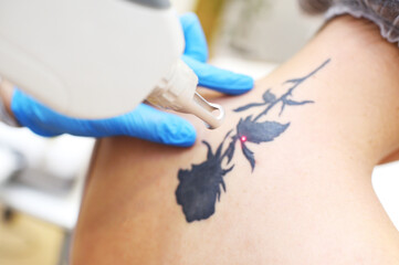 cosmetologist removes the tattoo to the patient using a neodymium laser in a modern clinic....