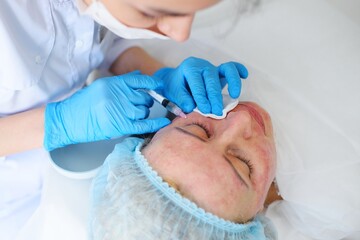 Obraz na płótnie Canvas cosmetologist makes a mesotherapy or plasmolifting procedure for the patient. Biorevitalization is a method of preventing skin aging by microinjections of hyaluronic acid.