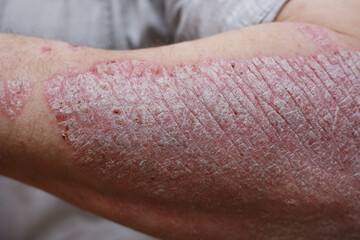Fototapeta premium Close up, macro of psoriasis skin, autoimmune disease that affects the skin cause skin inflammation red and scaly. Skin allergy with severe symptoms. Dermatitis rash and ugly eczema.