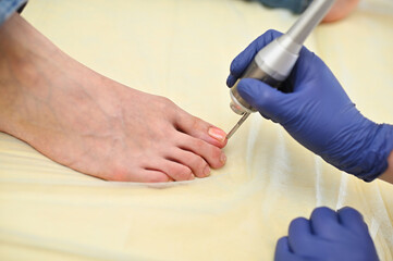 podologist is a woman using a laser to treat onychomycosis - a fungal nail disease. Hardware...