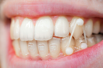 man use orthodontic rubber band on his teeth to correct his bite. Dental concept.