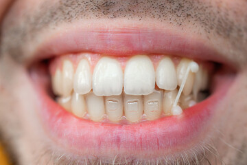 Young man use orthodontic rubber band on his teeth to correct his bite. Dental concept.