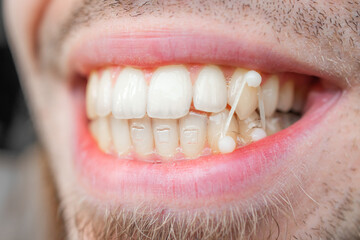 Young man pulls orthodontic elastics on his teeth to correct his bite. Dental concept. Isolated