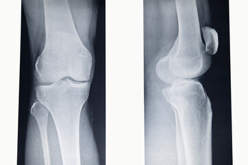 X-ray of the right female leg in the knee area, front and side view. Disease of the knee joint in the initial stage - Osteoarthritis.