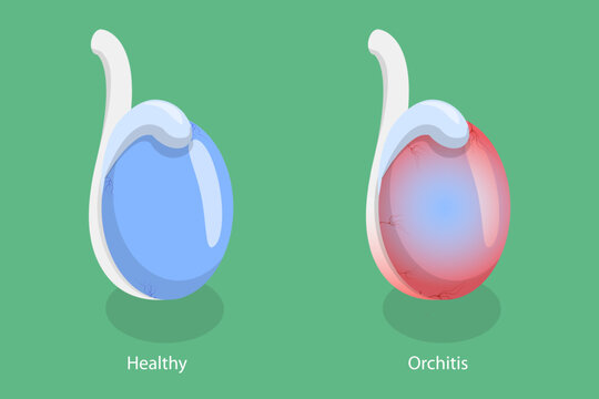 3D Isometric Flat Vector Conceptual Illustration of Orchitis, Inflammation of Testes