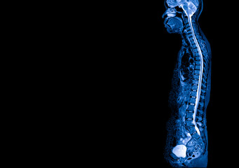 Blue tone radiograph on dark background in hospital.Doctor used MRI to diagnosis the illness of patient.MRI of human spine in sagittal or lateral view.Diagnosis of spine metastasis with back pain. - obrazy, fototapety, plakaty