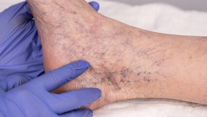 Varicose veins. Spider veins on the legs, treatment with sclerotherapy. Sclerotherapy.