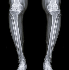 film x-ray  both Leg AP view  for diagnosis knee pain from osteoarthritis knee  and fracture .
