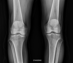 film x-ray  both knee joint  AP view  for diagnosis knee pain from osteoarthritis knee  and...