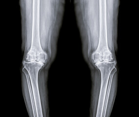 film x-ray  both knee joint  AP view  for diagnosis knee pain from osteoarthritis knee  and...