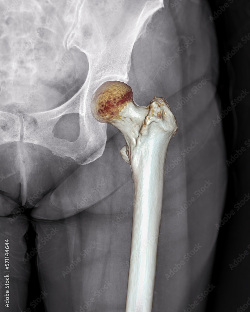 Poster x-ray of left hip joint front view with 3d rendering of left femur .